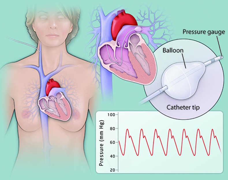 Chronic Thromboembolic Pulmonary Hypertension (CTEPH): Diagnosis and Treatment in the USA